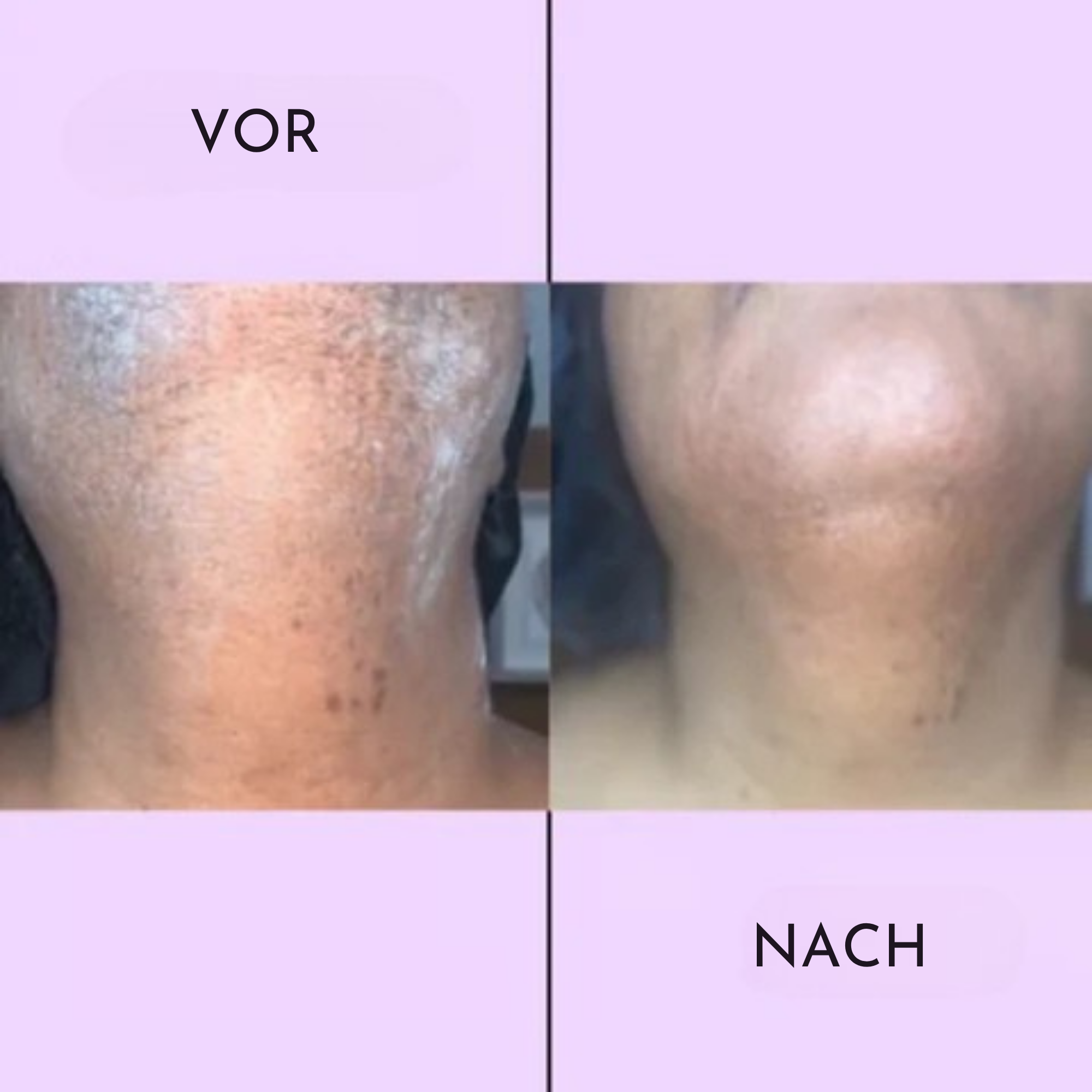 SanftSchön™ / Mühelose Haarentfernungscreme
