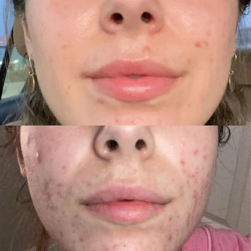 LichtLuxe™ / Schmerzfreie Behandlung Und Nicht-Invasive Therapie