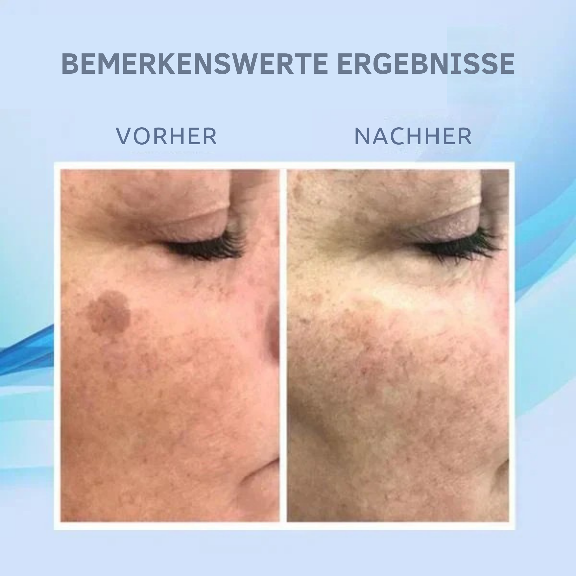 Monika – Entferner dunkler Hautflecken in nur wenigen Wochen