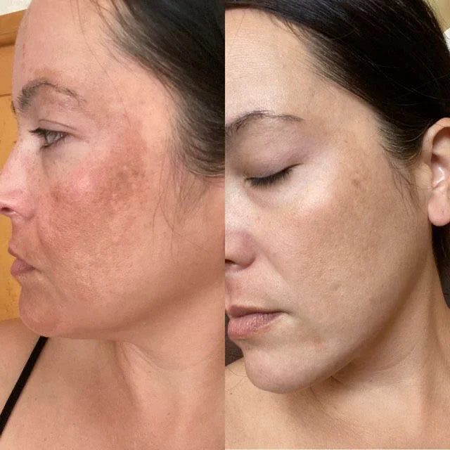 LichtLuxe™ / Schmerzfreie Behandlung Und Nicht-Invasive Therapie