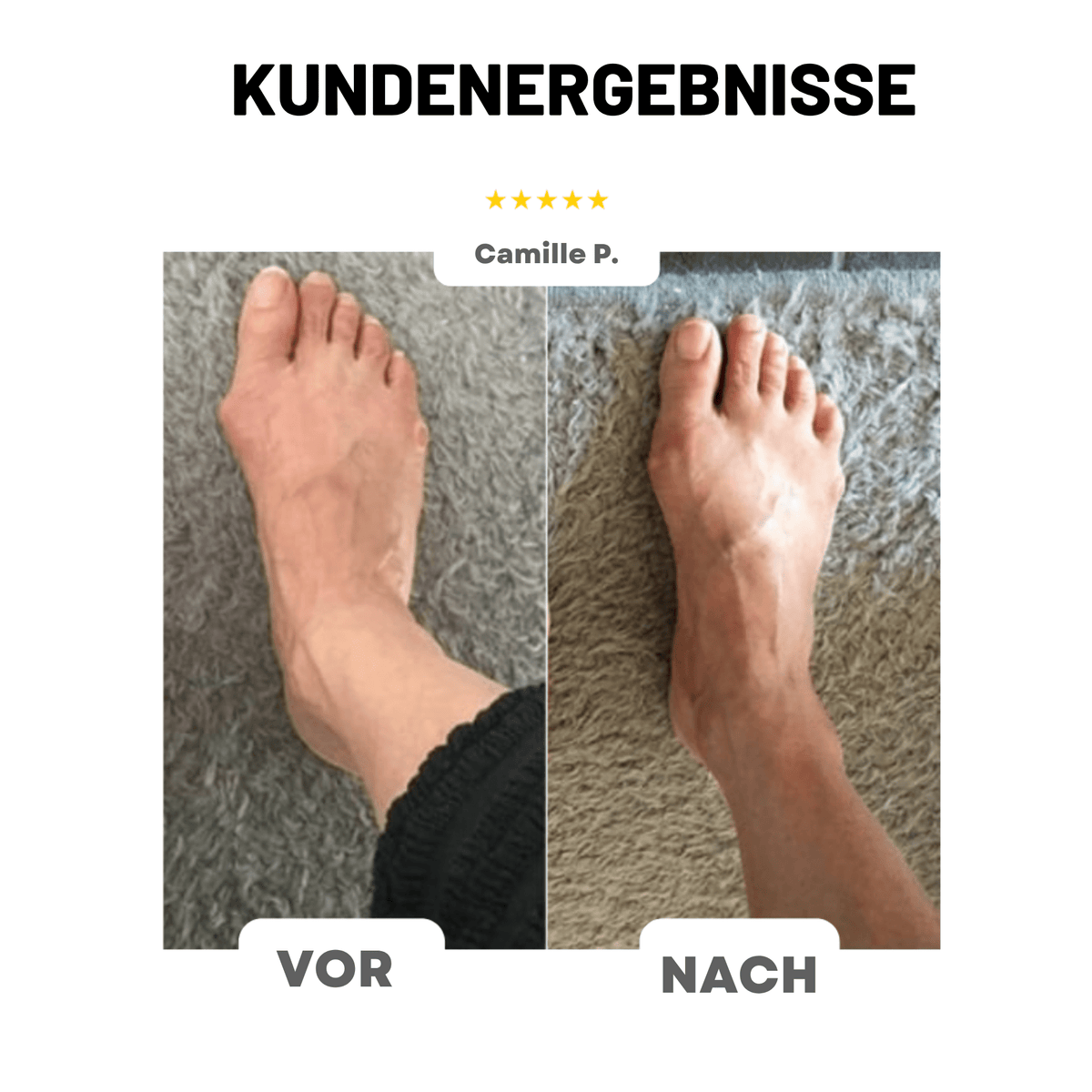 FußForm™ / Hallux Valgus Korrektur - Sopheria