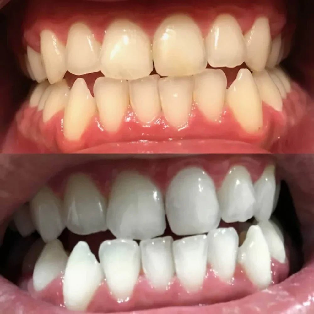 SmileSchein™ / Zahnaufhellungsstift – Strahlendes Lächeln in 10 Minuten - Sopheria