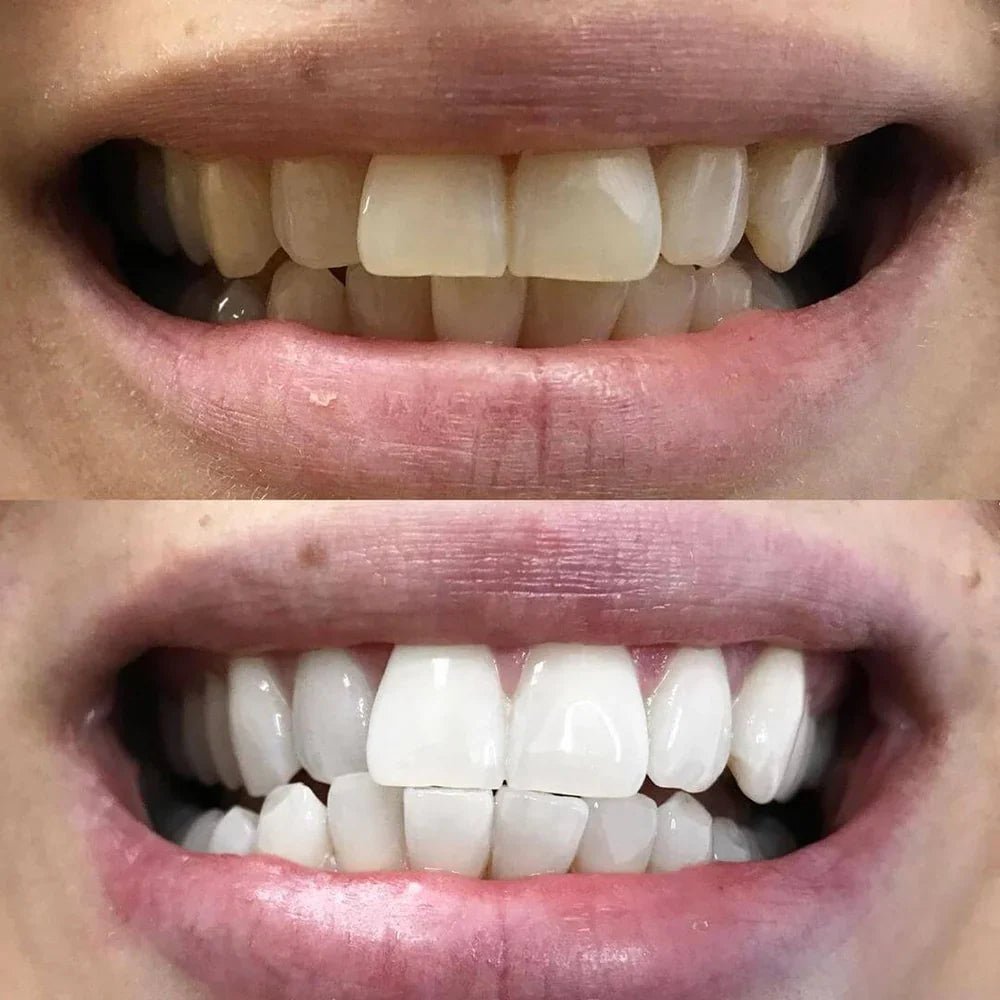 SmileSchein™ / Zahnaufhellungsstift – Strahlendes Lächeln in 10 Minuten - Sopheria