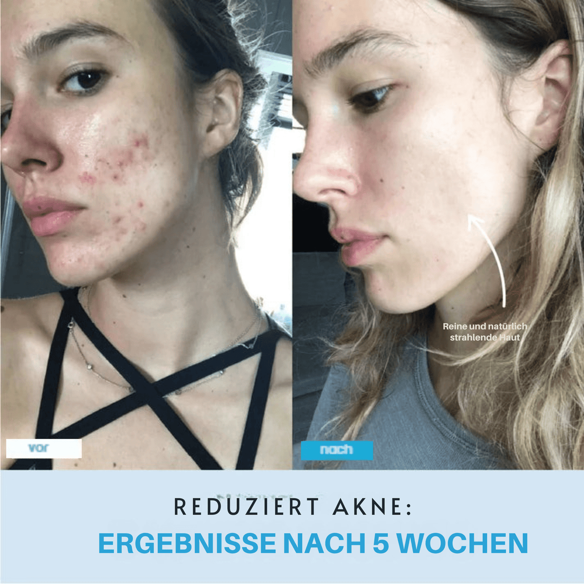 StraffStrom™ / Kombiniert LED-Lichttherapie mit Lifting-Effekten - Sopheria