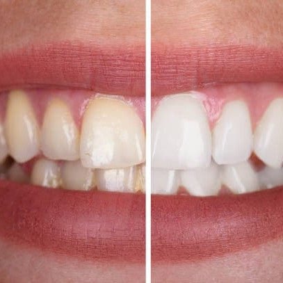 Whitening Gel – Für ein strahlendes Lächeln - Sopheria
