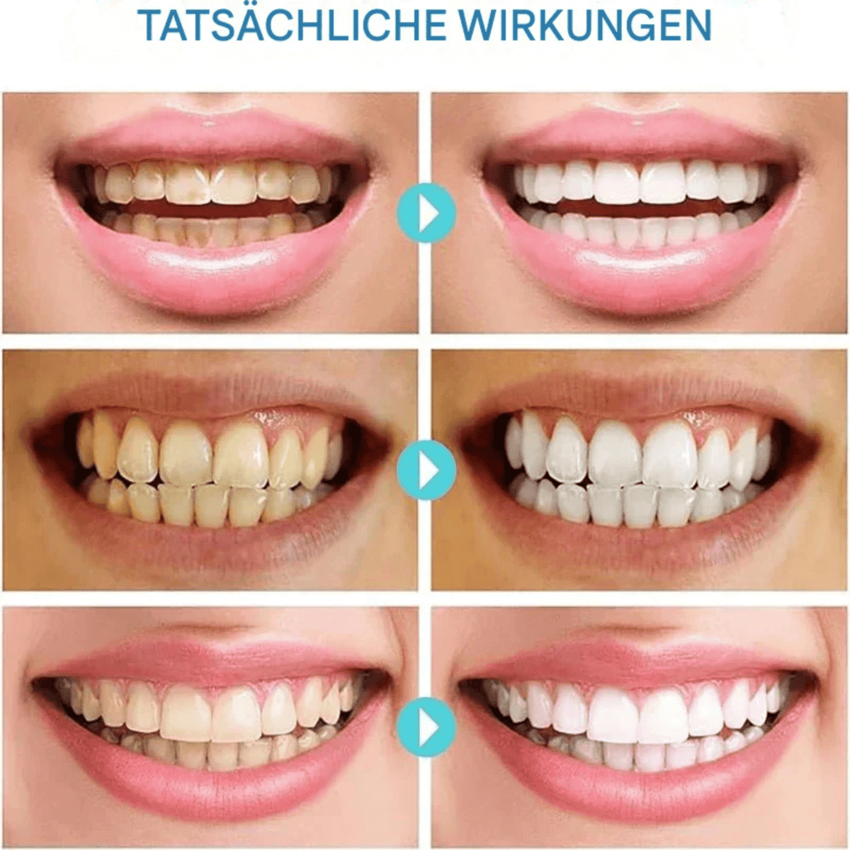 ZahnZart™ / Sofortige Aufhellung - Sopheria