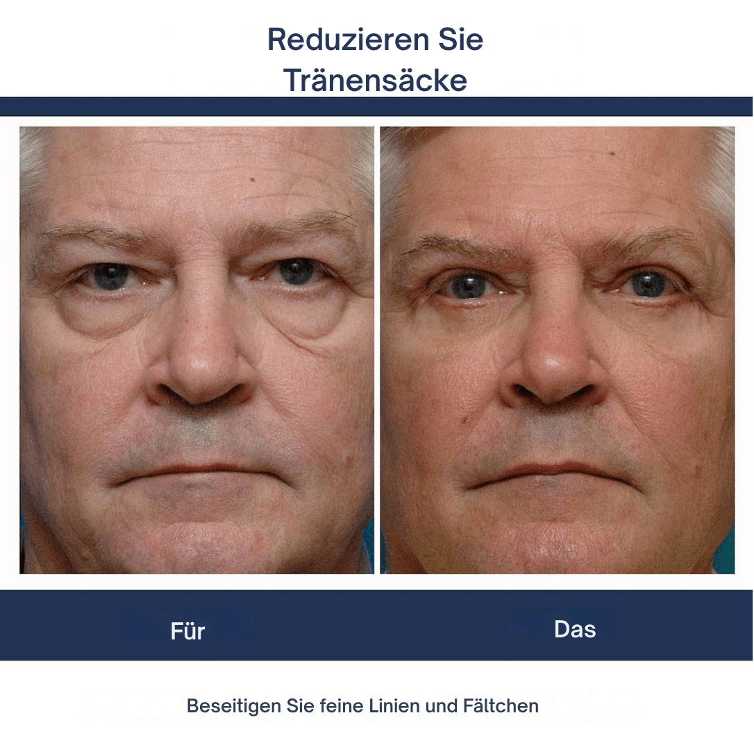 1 + 1 GRATIS | Leon™ Verjüngendes Augenlifting-Gel für Männer und Frauen - Sopheria