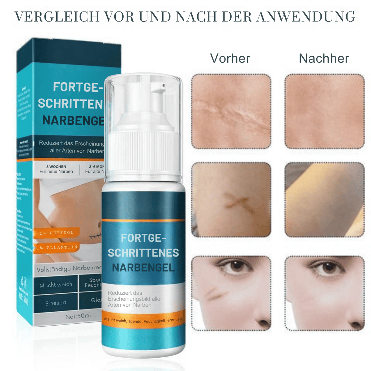 1+1 GRATIS | Littekengel Leonie zur sichtbaren Narbenmilderung - Sopheria