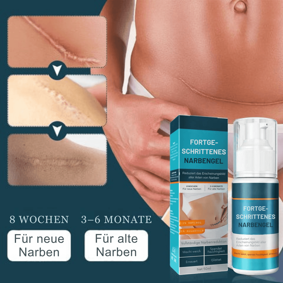 1+1 GRATIS | Littekengel Leonie zur sichtbaren Narbenmilderung - Sopheria