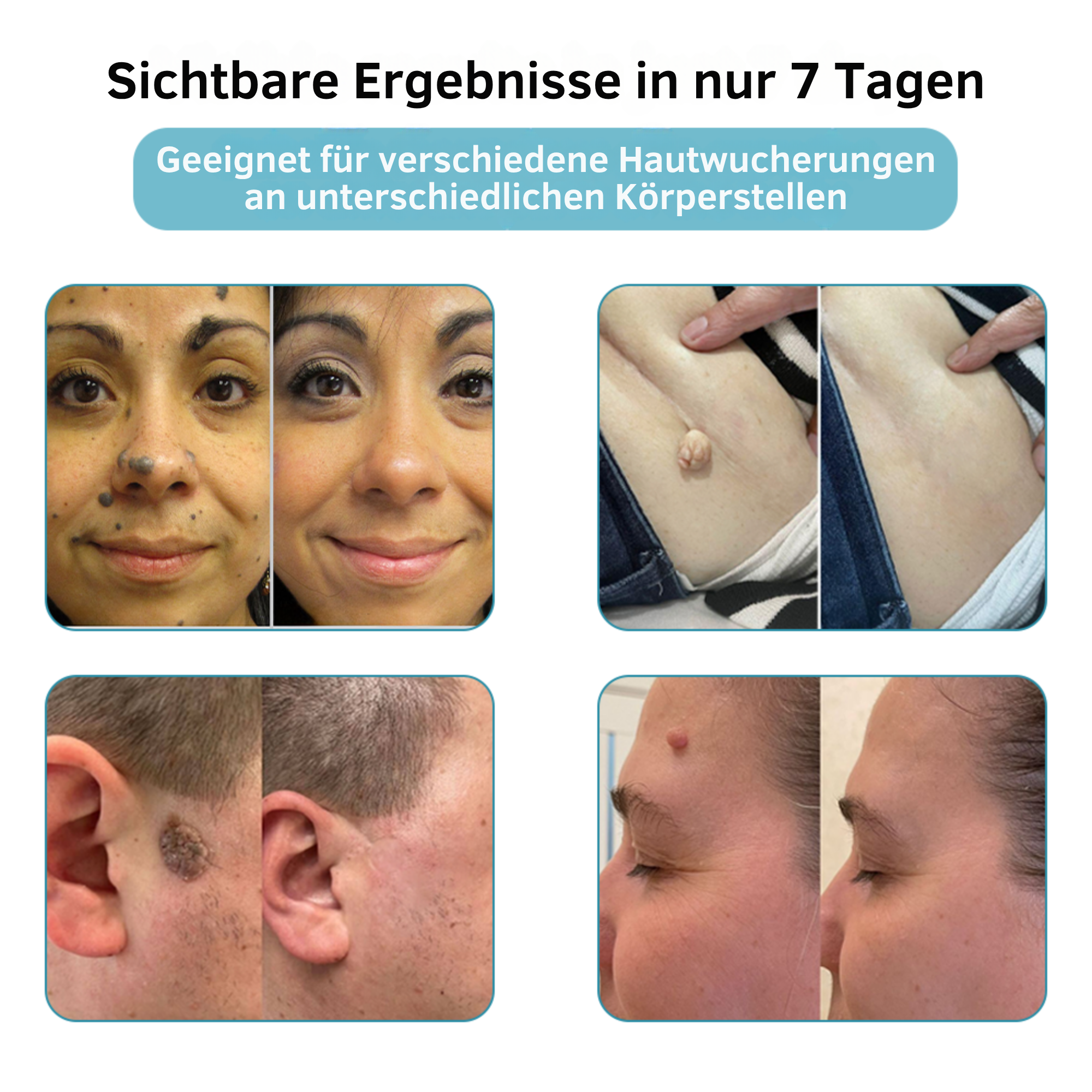 Klara® Schmerzfreier Laserstift zur Entfernung von Muttermalen und Warzen – Promax Edition