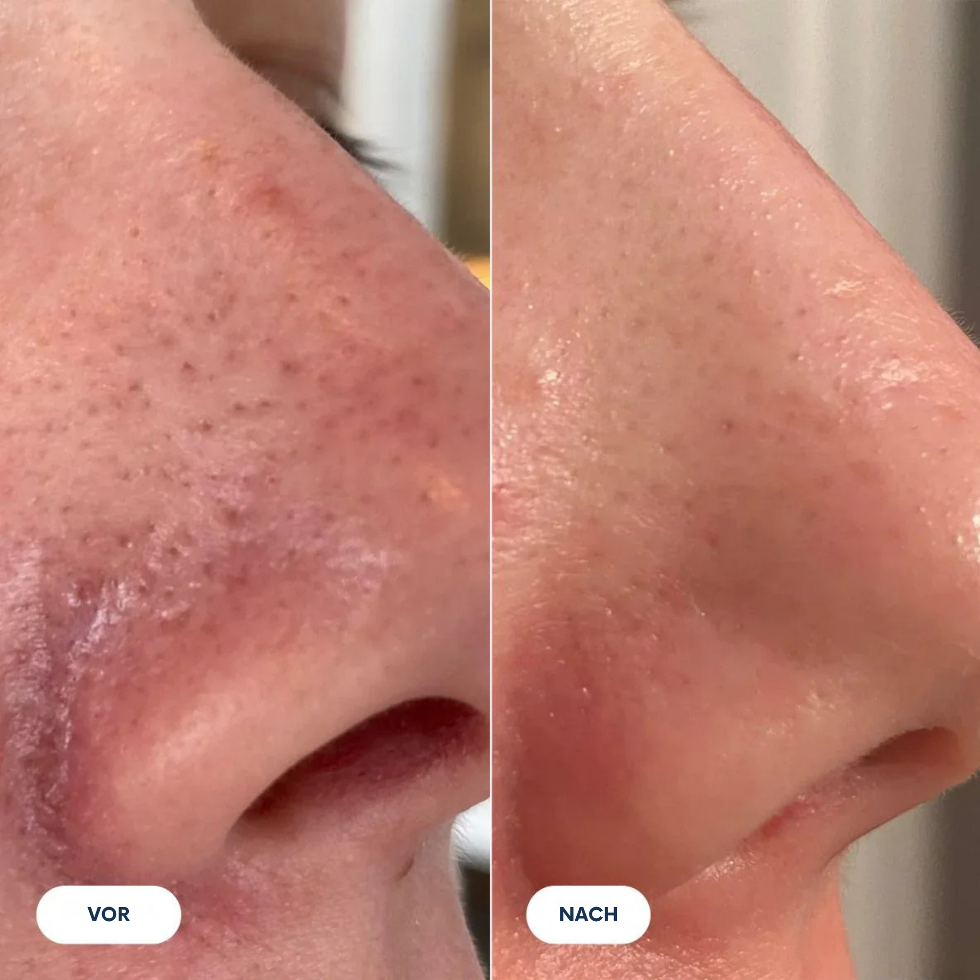 ReisRein™ / Reis-Peeling-Duo