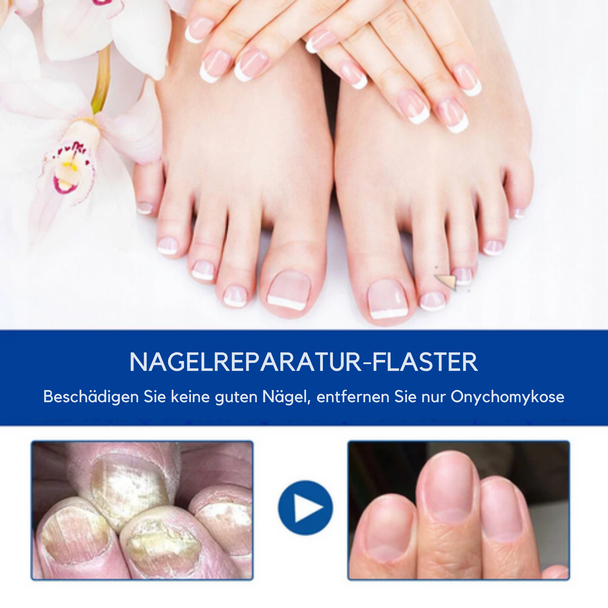 NagelNeuer / Wirksame Behandlung Von Nagelpilz (1+1 GRATIS)