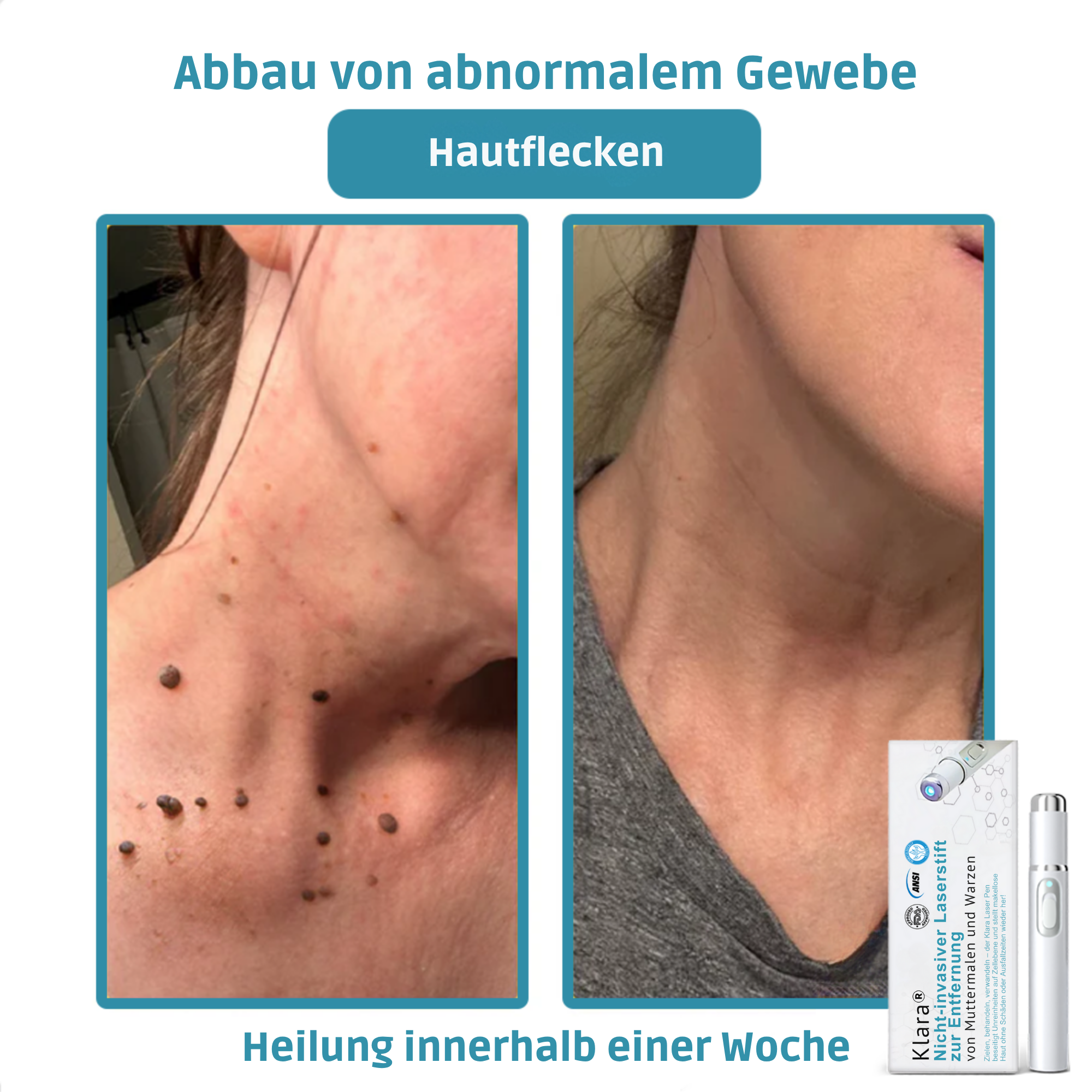 Klara® Schmerzfreier Laserstift zur Entfernung von Muttermalen und Warzen – Promax Edition