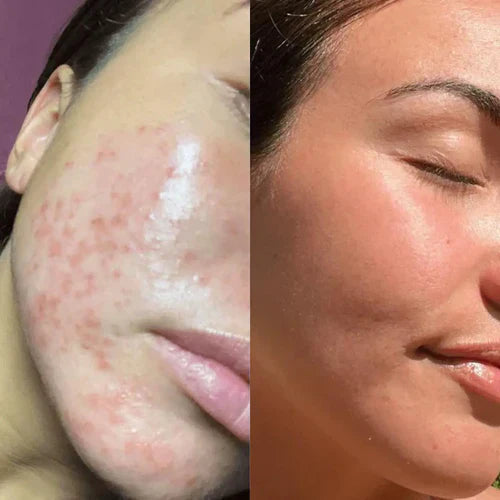 LichtLuxe™ / Schmerzfreie Behandlung Und Nicht-Invasive Therapie