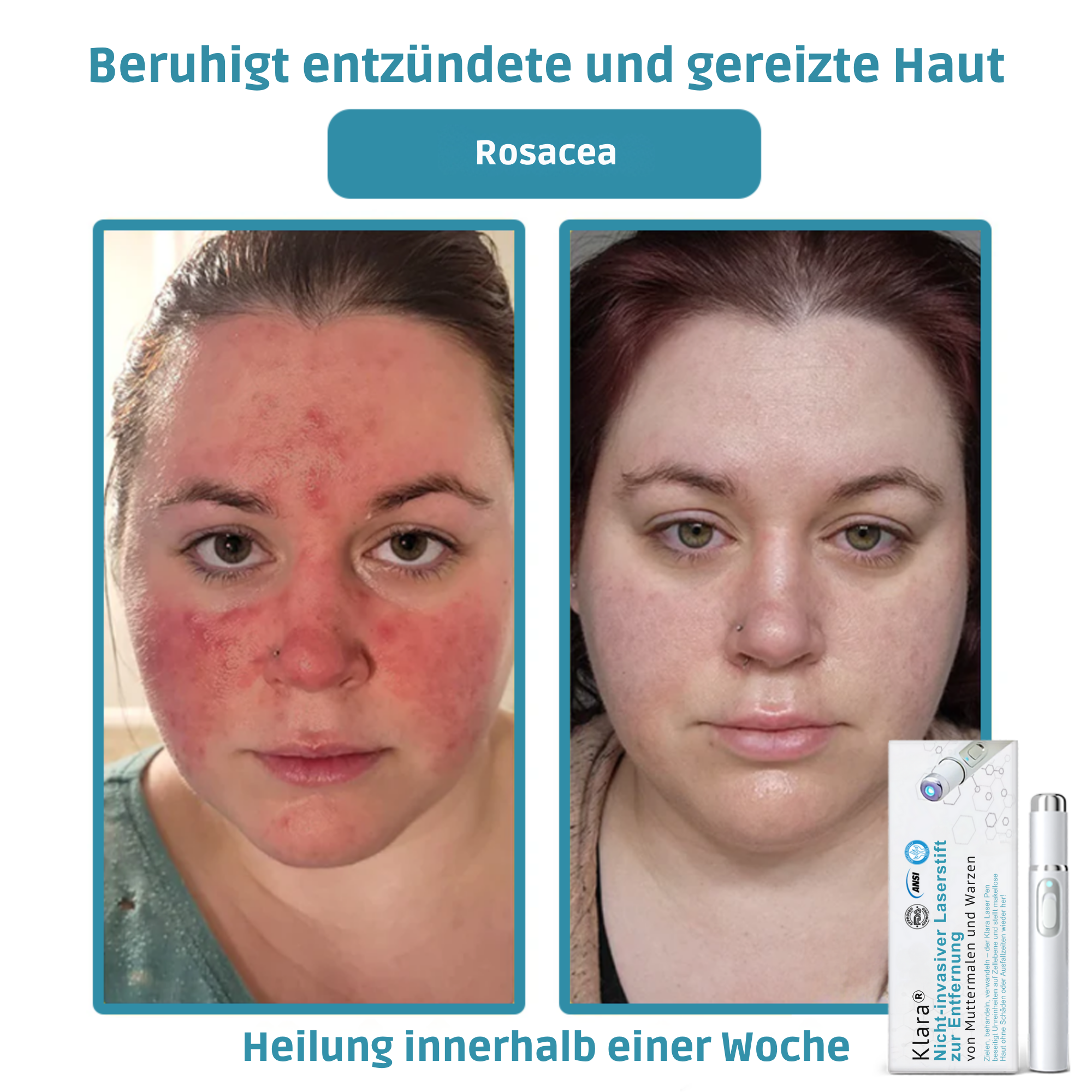Klara® Schmerzfreier Laserstift zur Entfernung von Muttermalen und Warzen – Promax Edition