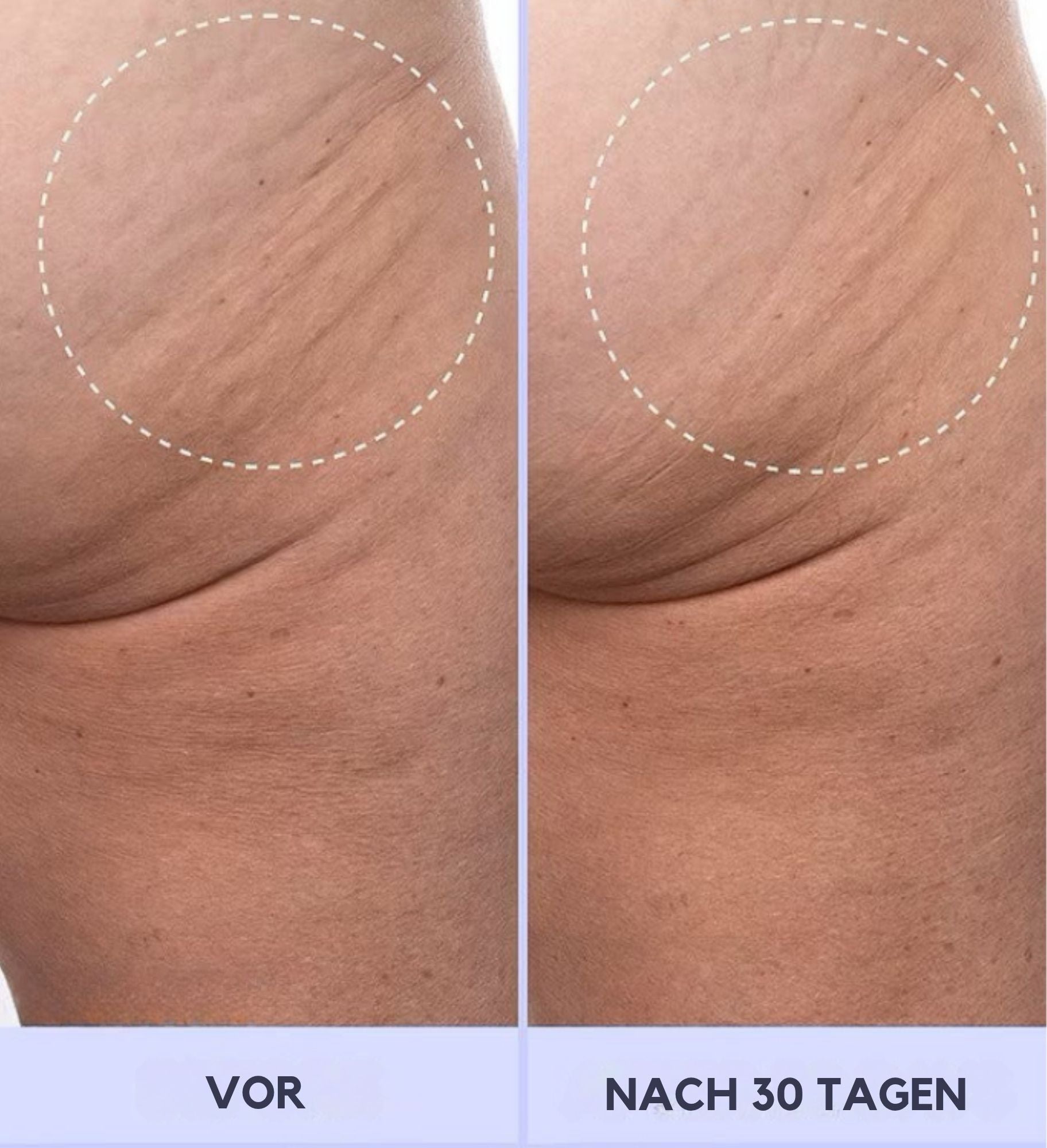 StraffSchön™ / Sag Hallo Zu Sichtbar Strafferer Haut! (1+1 GRATIS)