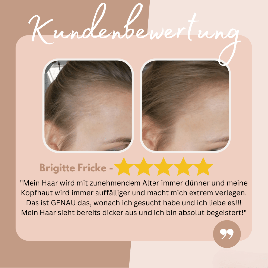 AnsatzAde™ / Sag Lebewohl zu Deinem Haaransatz! (1+1 GRATIS) - Sopheria