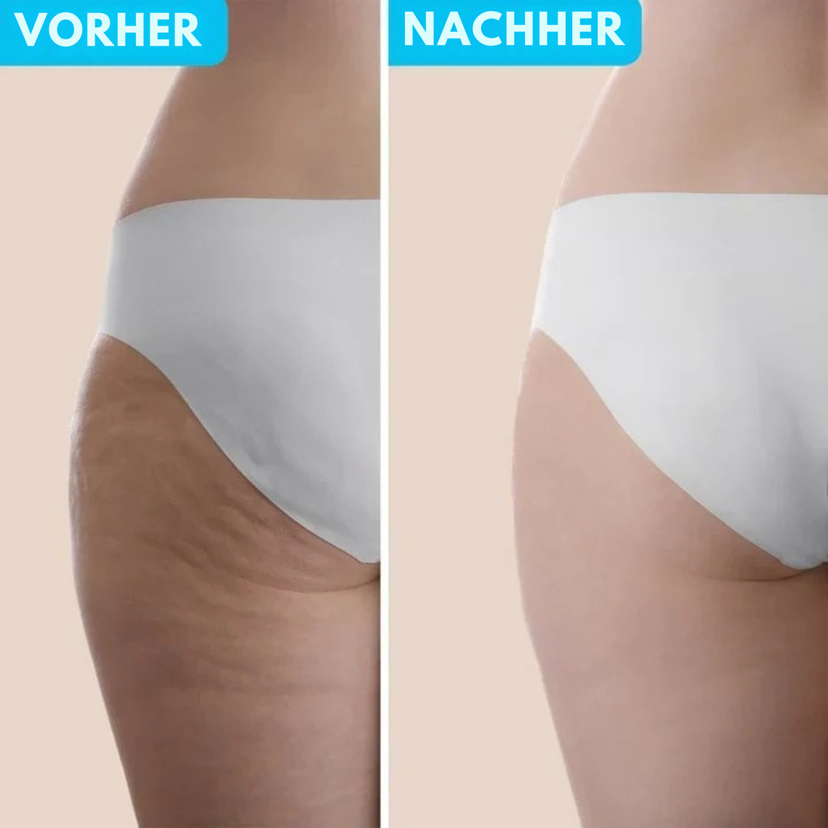CelluSilk™ / Entferne Cellulite bequem von zu Hause aus! - Sopheria