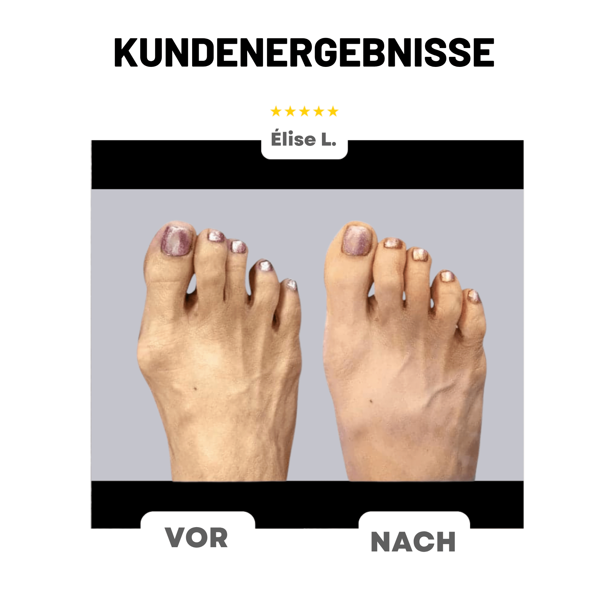 FußForm™ / Hallux Valgus Korrektur - Sopheria