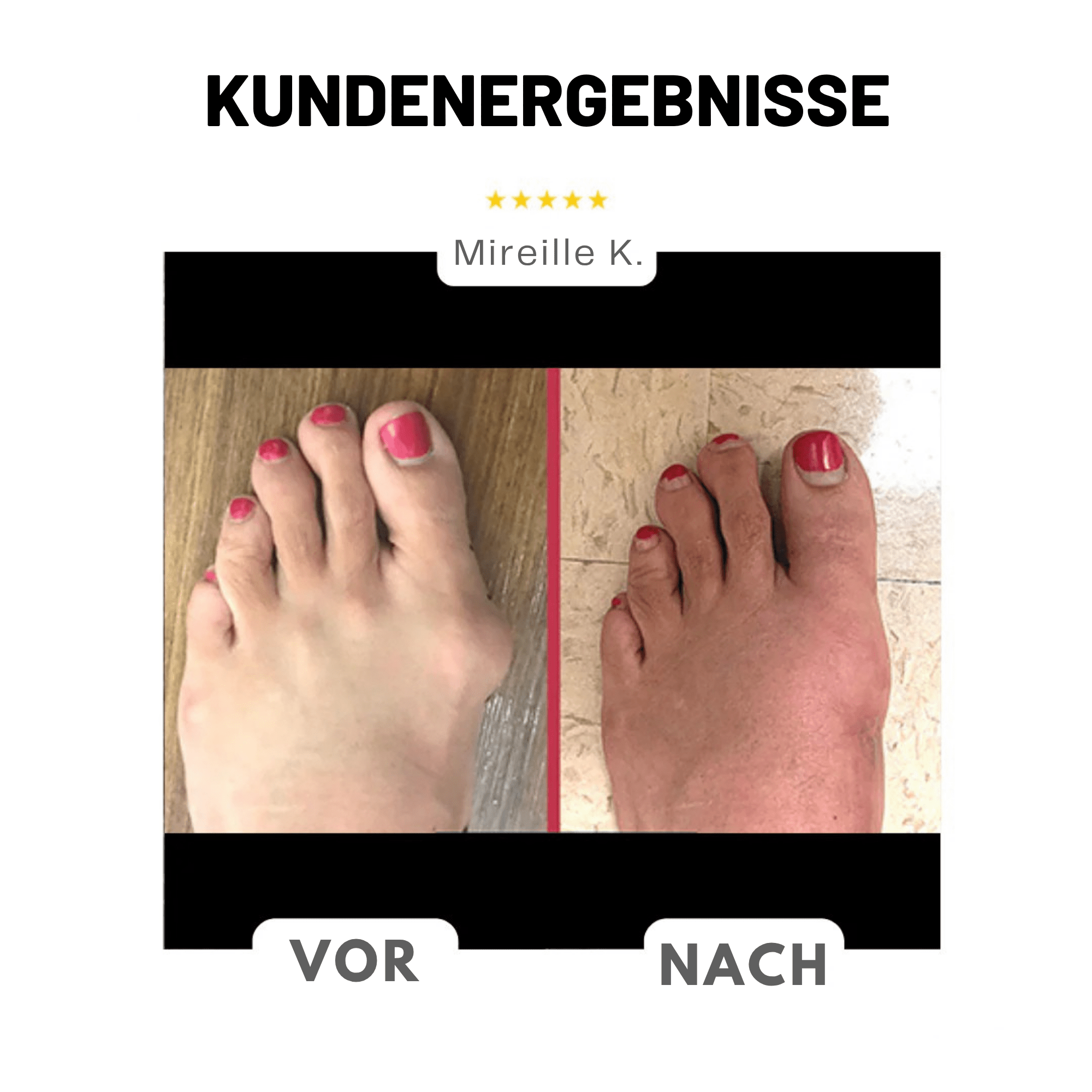 FußForm™ / Hallux Valgus Korrektur - Sopheria