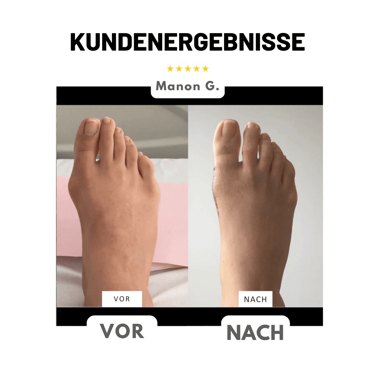 FußForm™ / Hallux Valgus Korrektur - Sopheria