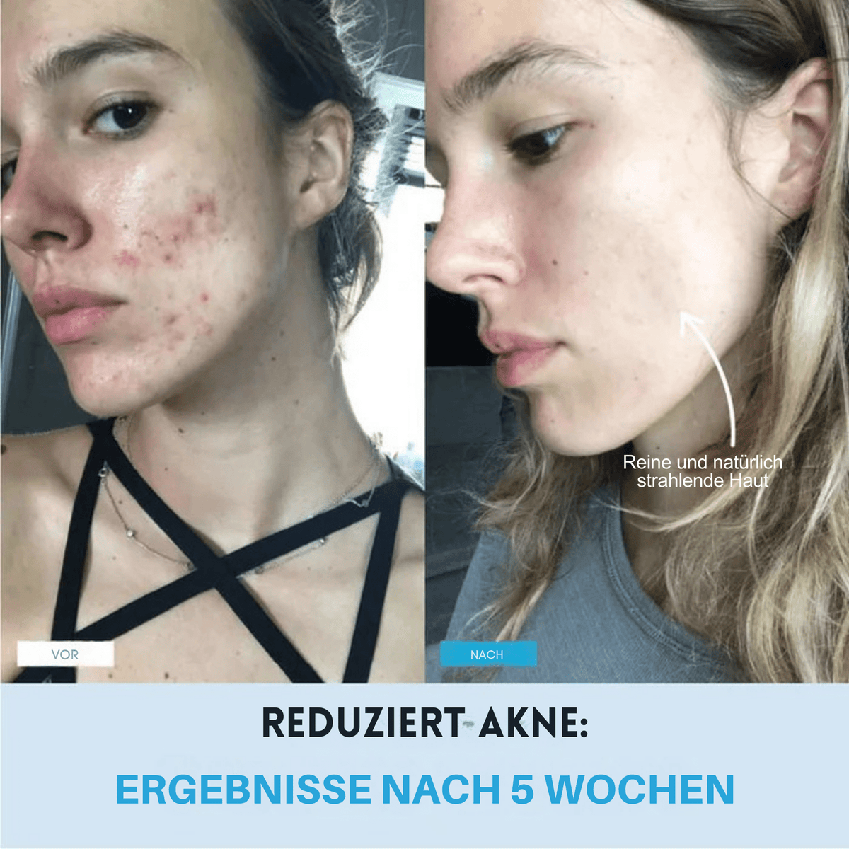 KinnKontur™ / Für eine sichtbar definierte Kinnlinie in nur 5 Minuten täglich - Sopheria