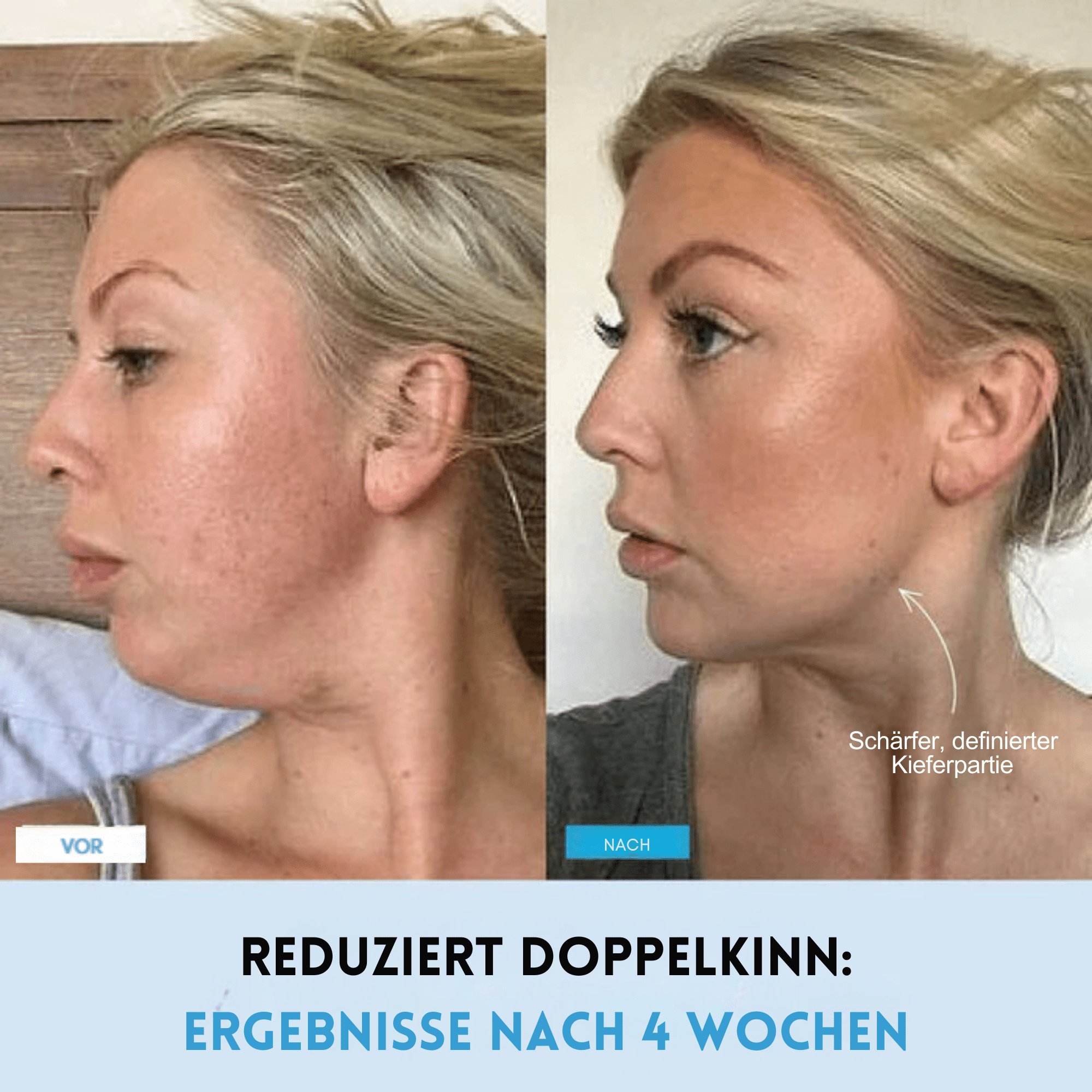 KinnKontur™ / Für eine sichtbar definierte Kinnlinie in nur 5 Minuten täglich - Sopheria