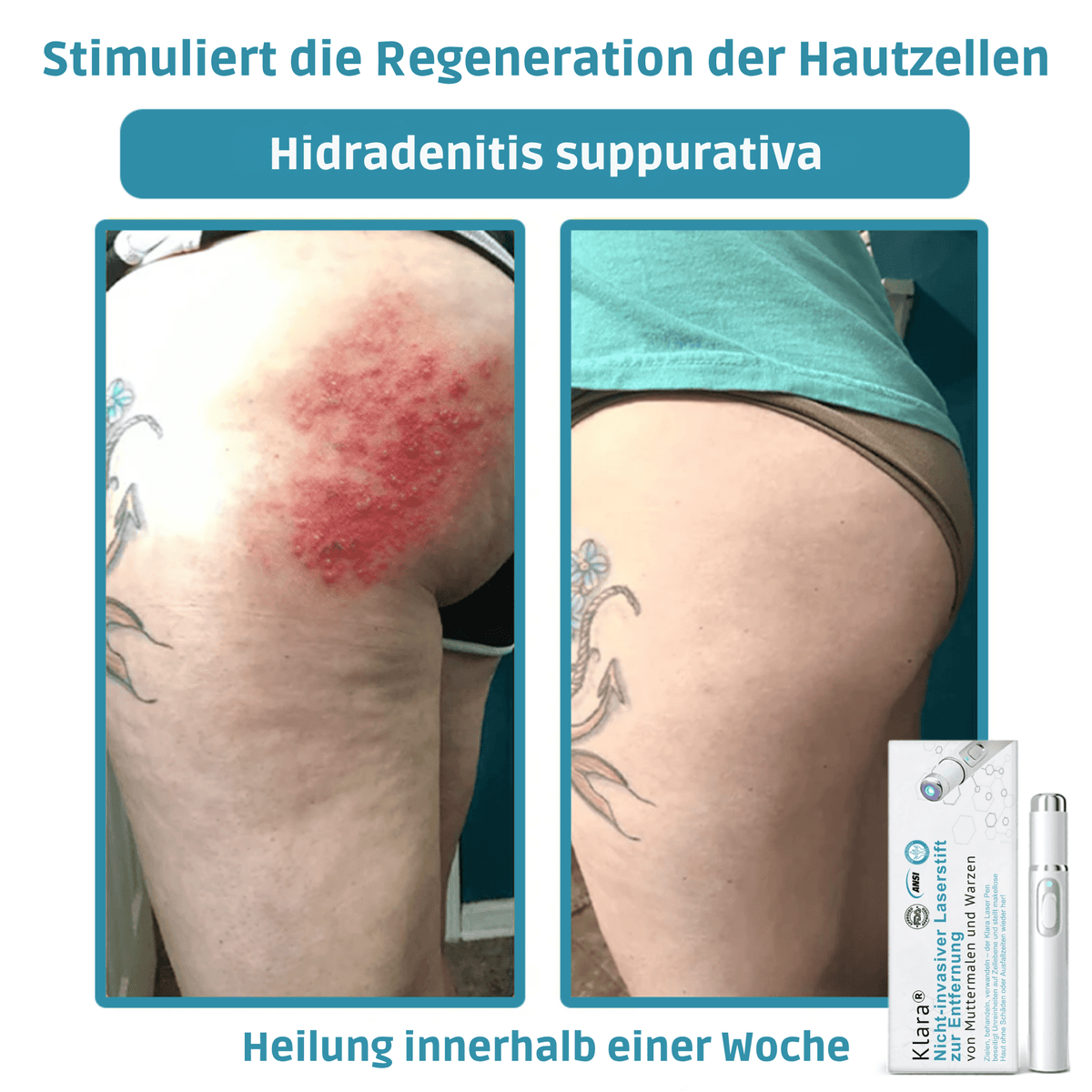 Klara® Schmerzfreier Laserstift zur Entfernung von Muttermalen und Warzen – Promax Edition - Sopheria