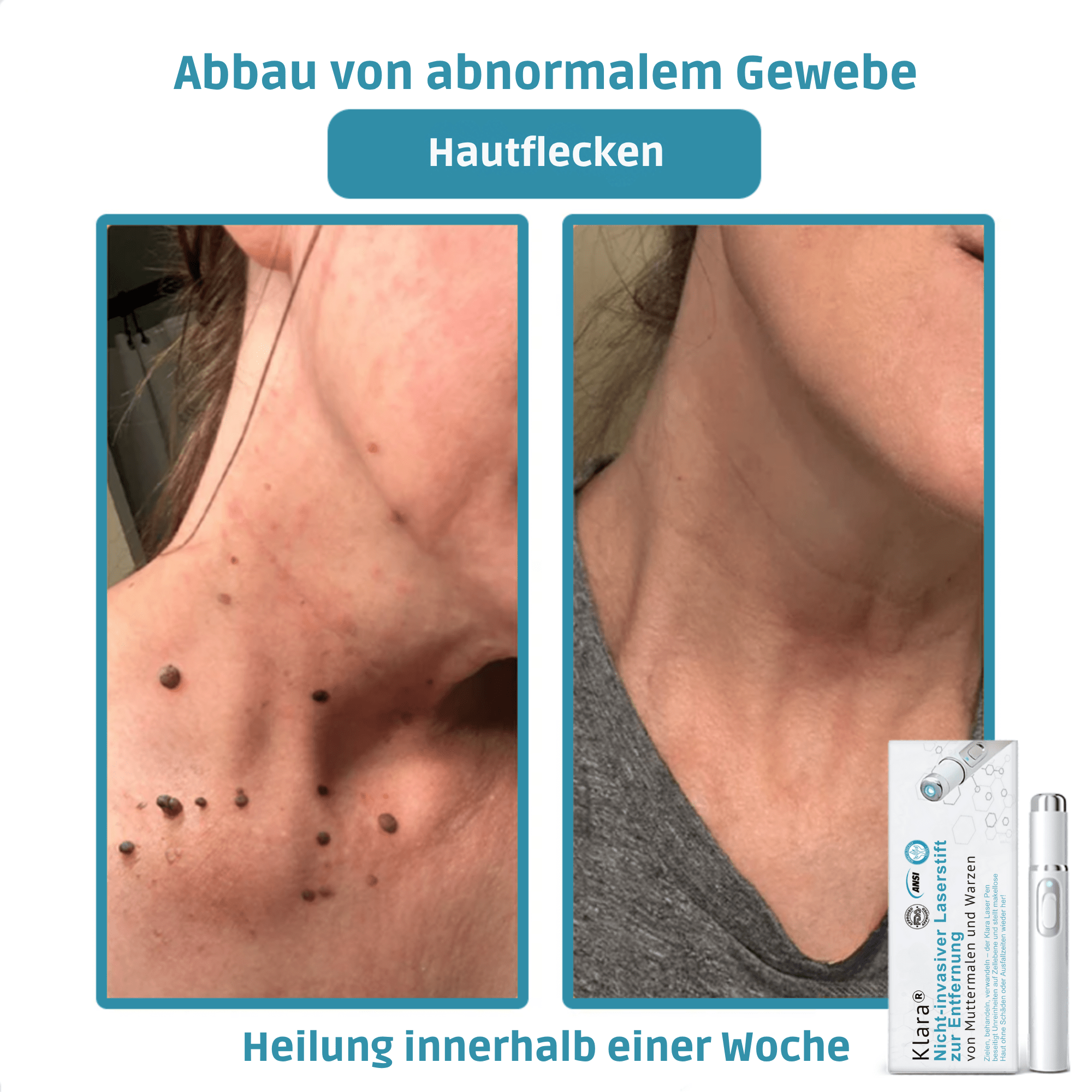 Klara® Schmerzfreier Laserstift zur Entfernung von Muttermalen und Warzen – Promax Edition - Sopheria