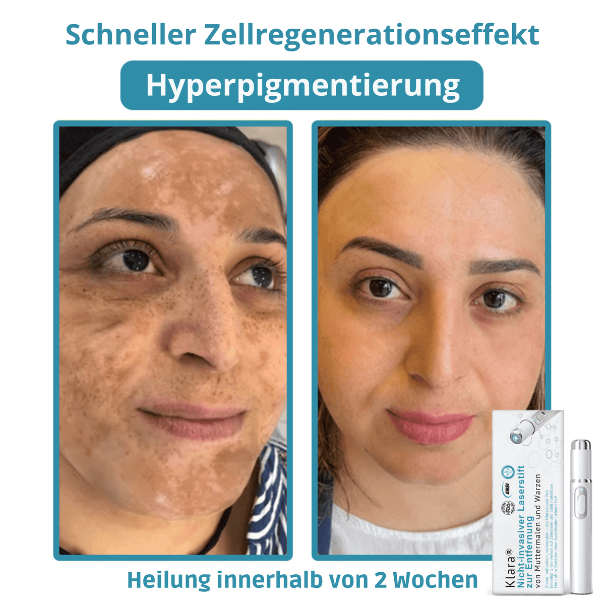 Klara® Schmerzfreier Laserstift zur Entfernung von Muttermalen und Warzen – Promax Edition - Sopheria