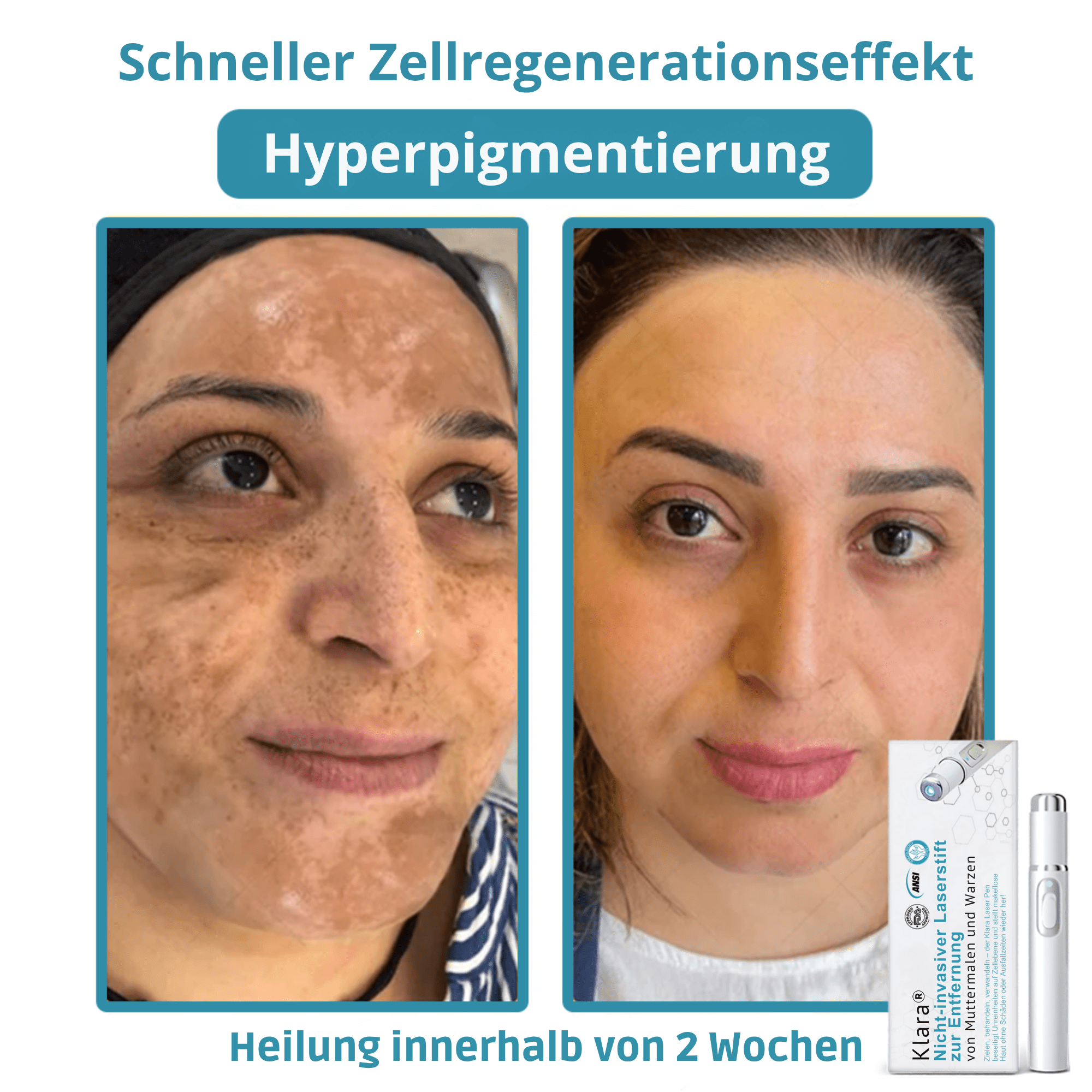 Klara® Schmerzfreier Laserstift zur Entfernung von Muttermalen und Warzen – Promax Edition - Sopheria