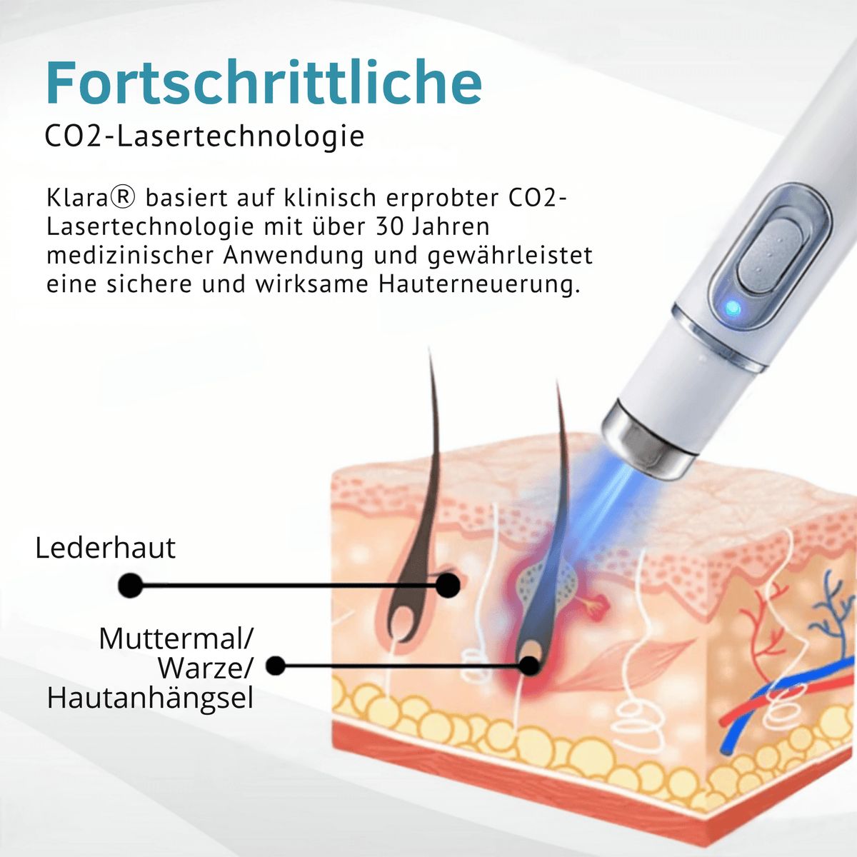 Klara® Schmerzfreier Laserstift zur Entfernung von Muttermalen und Warzen – Promax Edition - Sopheria