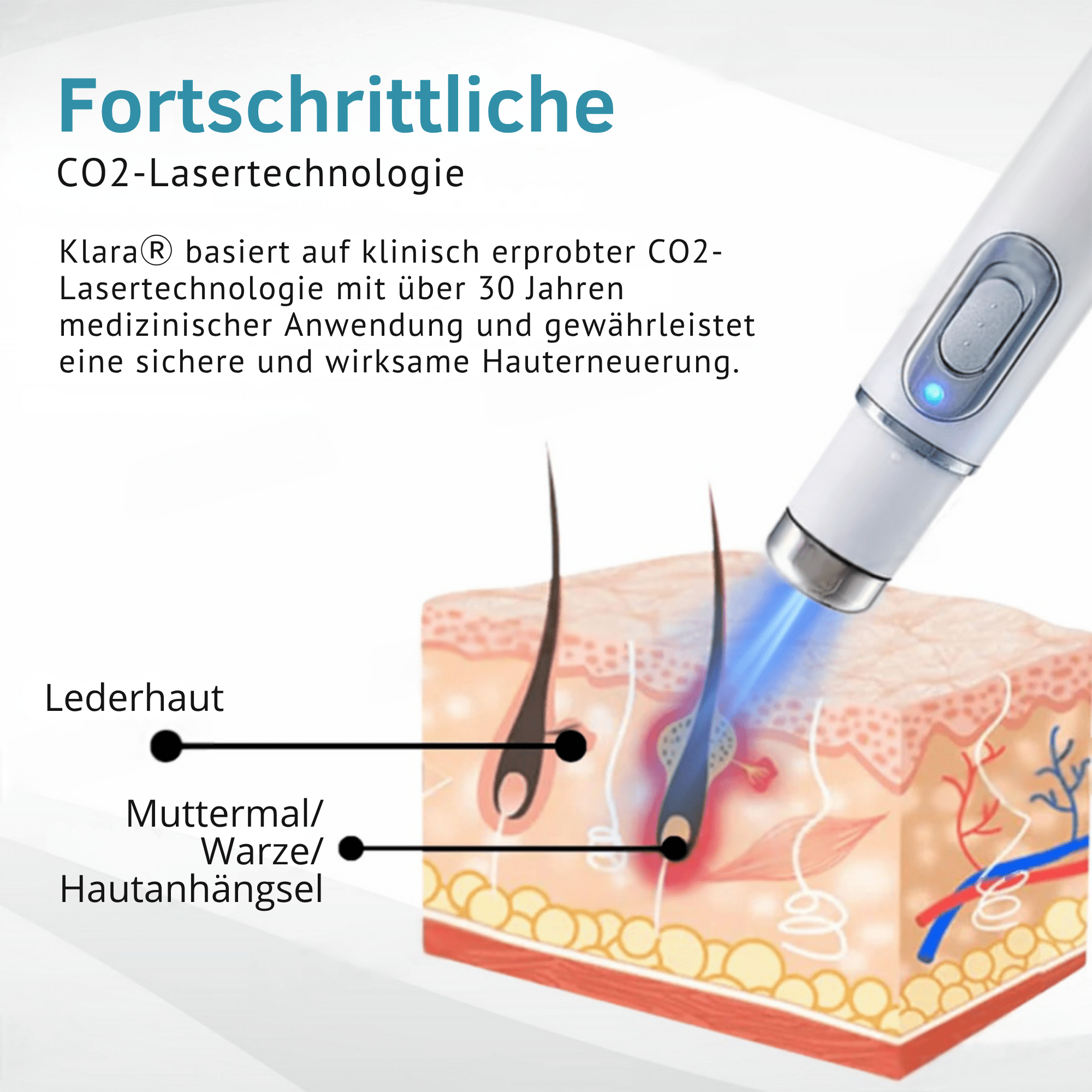 Klara® Schmerzfreier Laserstift zur Entfernung von Muttermalen und Warzen – Promax Edition - Sopheria