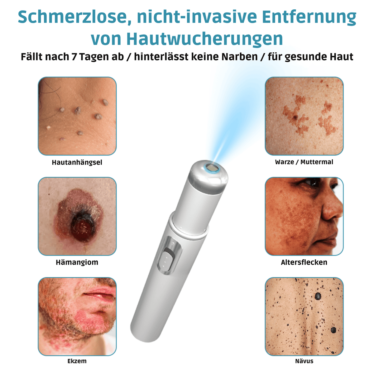Klara® Schmerzfreier Laserstift zur Entfernung von Muttermalen und Warzen – Promax Edition - Sopheria