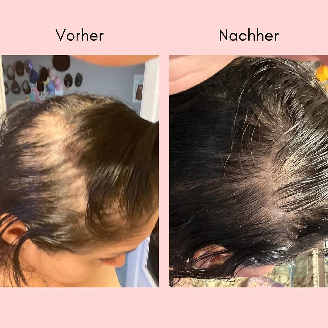 KraftKopfhaut™ / Natürliches Haaröl gegen sichtbaren Haarausfall & dünner werdendes Haar - Sopheria