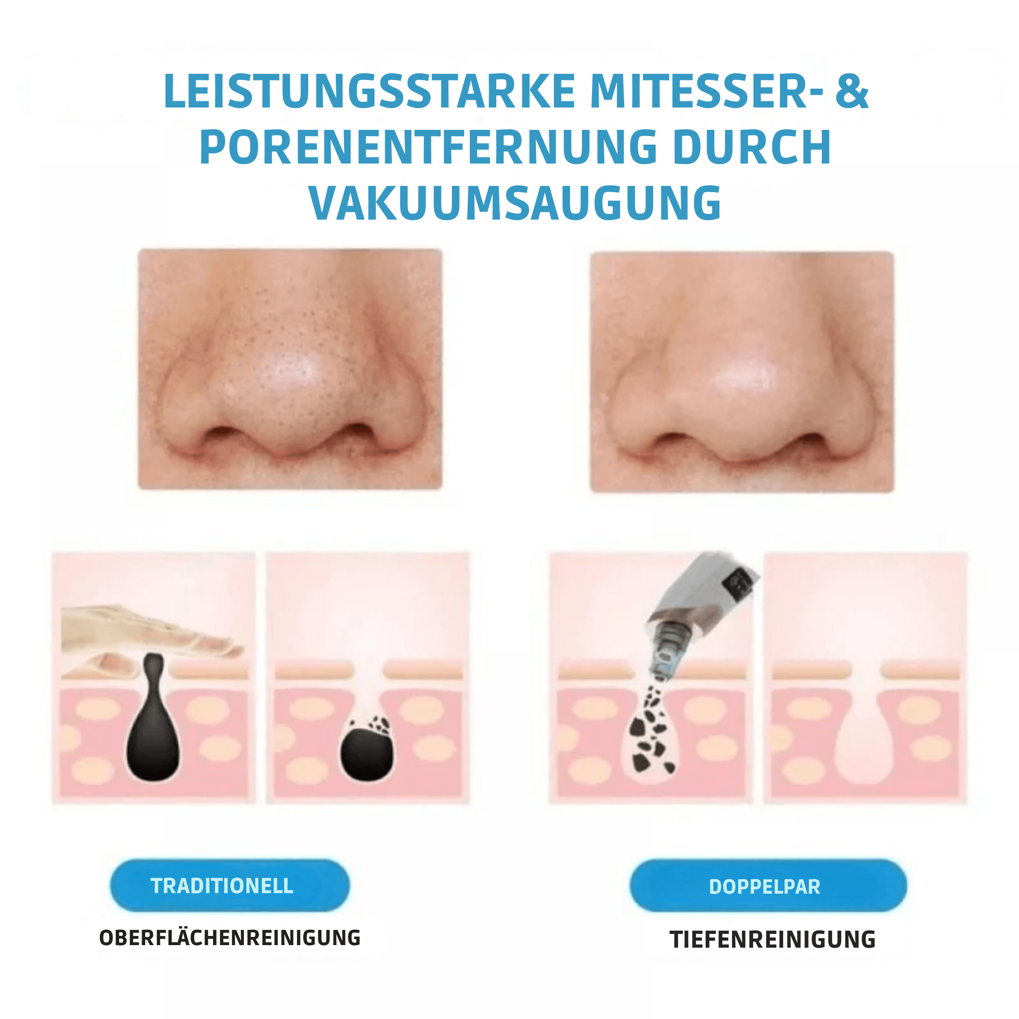 MitesserMeister™ / Elektrischer Mitesserentferner - Sopheria