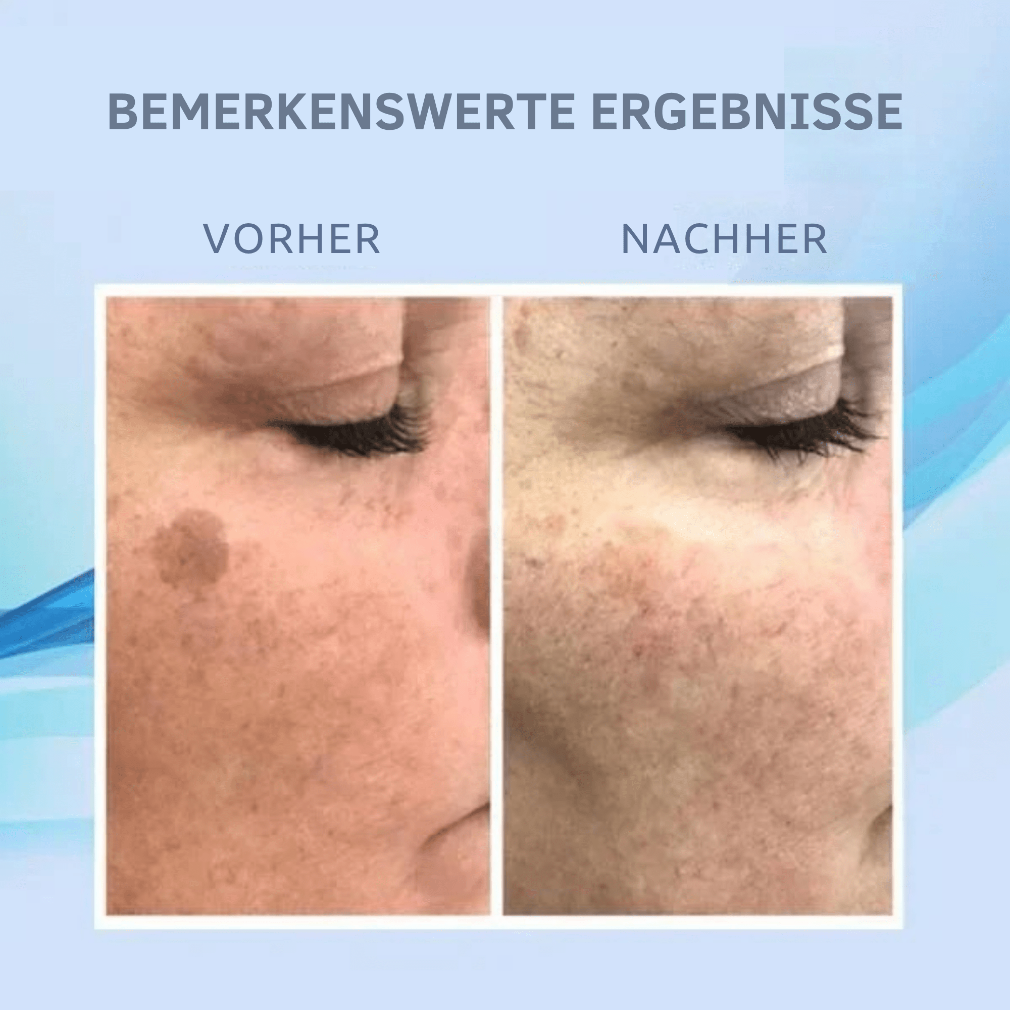 Monika – Entferner dunkler Hautflecken in nur wenigen Wochen - Sopheria