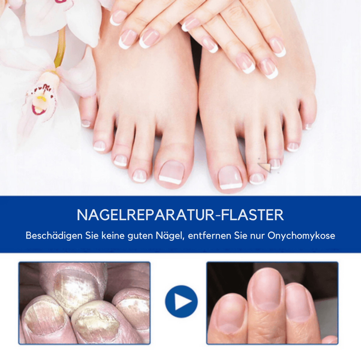 NagelNeuer / Wirksame Behandlung Von Nagelpilz (1+1 GRATIS) - Sopheria