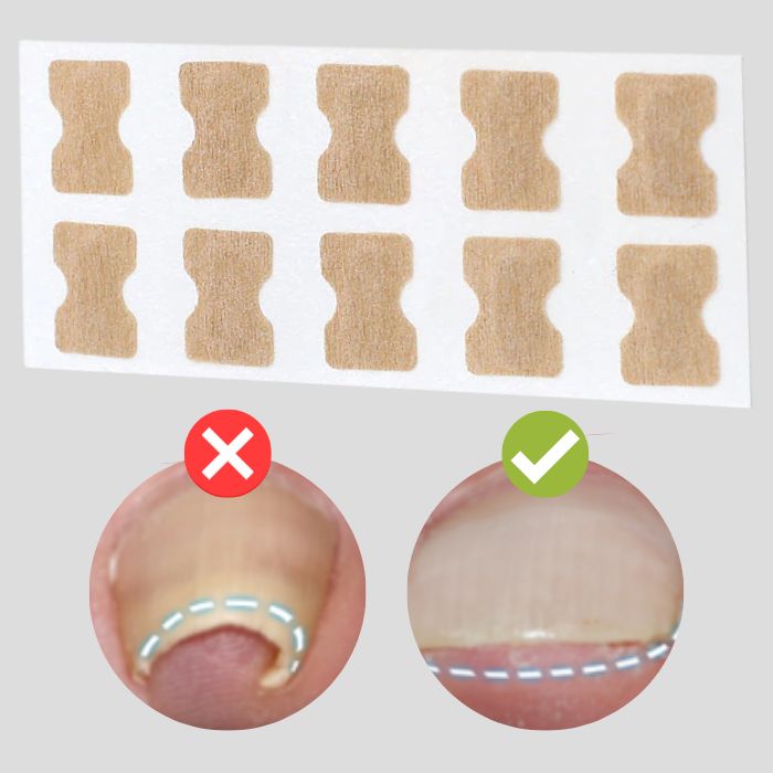 PediPure™ / Nagelkorrektur-Patches (100 Stück) - Sopheria