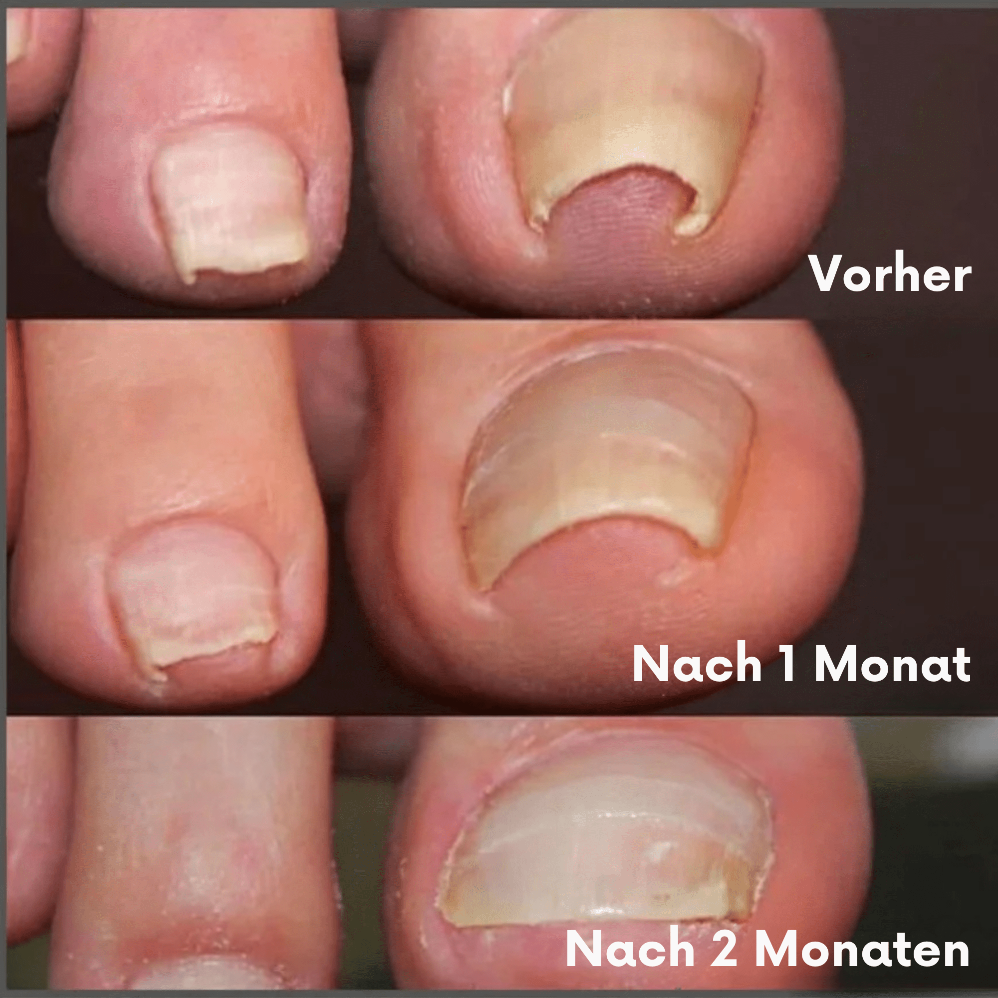 PediPure™ / Nagelkorrektur-Patches (100 Stück) - Sopheria