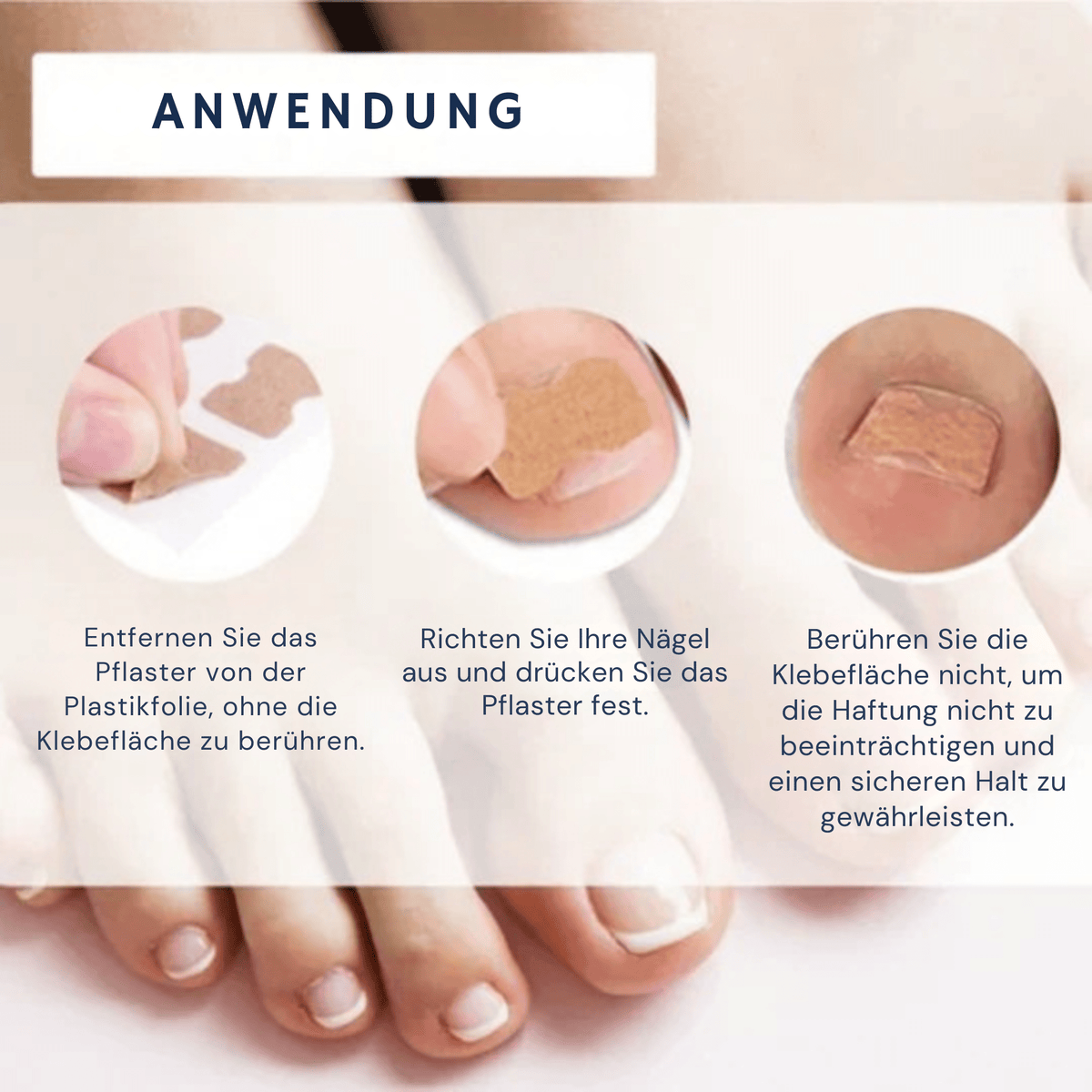 PediPure™ / Nagelkorrektur-Patches (100 Stück) - Sopheria