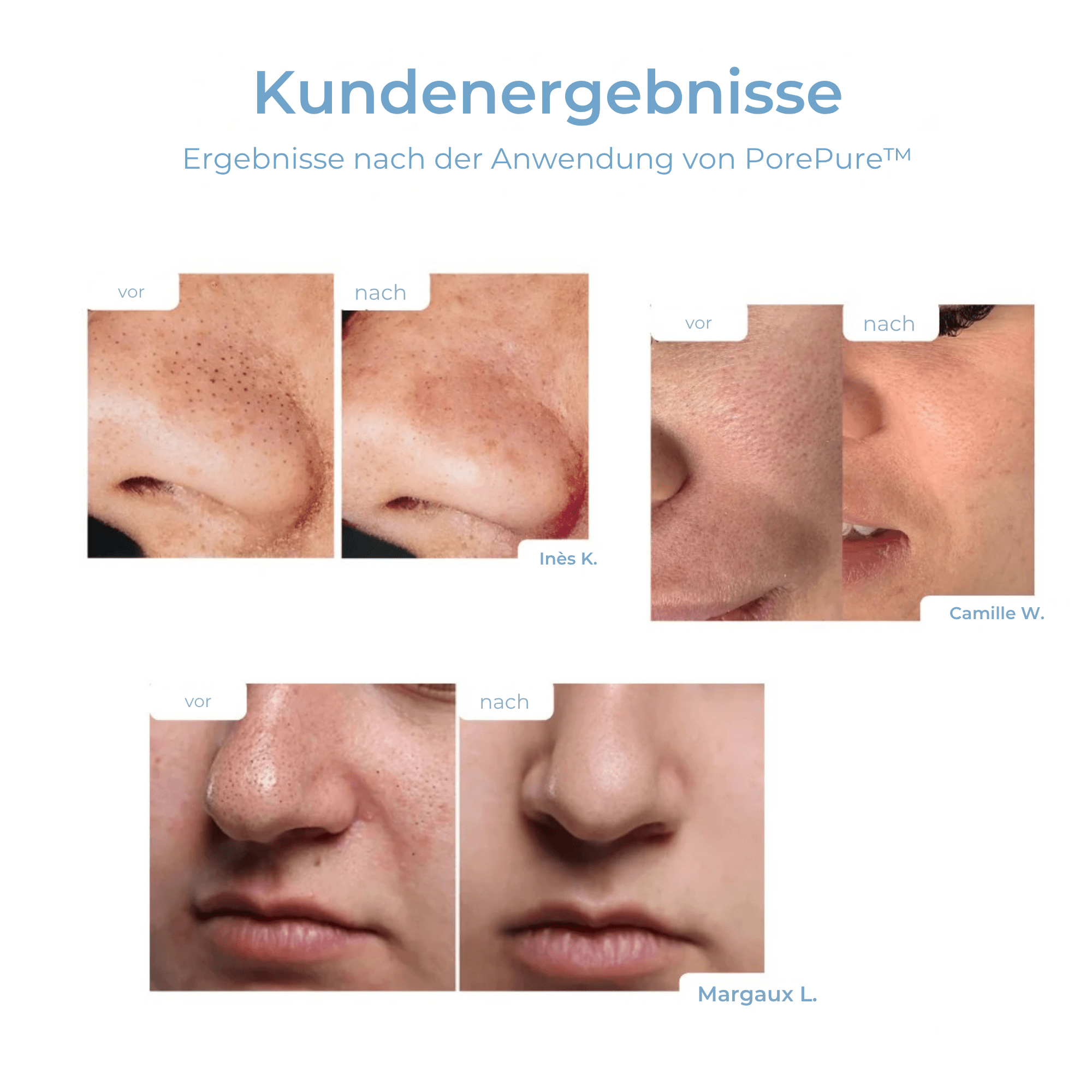 PorePure™ / Porenreinigendes Serum (5+5 GRATIS) - Sopheria