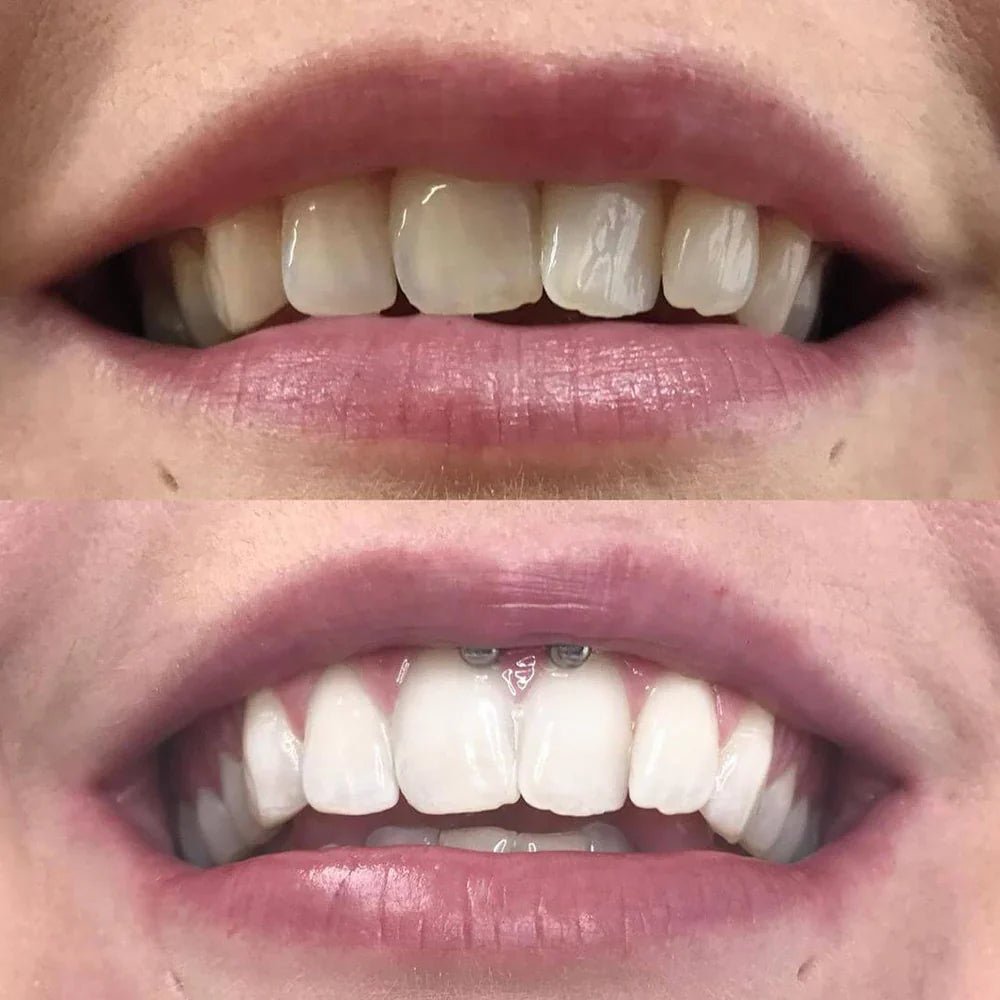 SmileSchein™ / Zahnaufhellungsstift – Strahlendes Lächeln in 10 Minuten - Sopheria