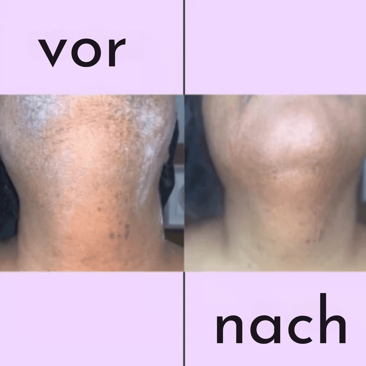 SoftSchön™ / Mühelose Haarentfernungscreme - Sopheria