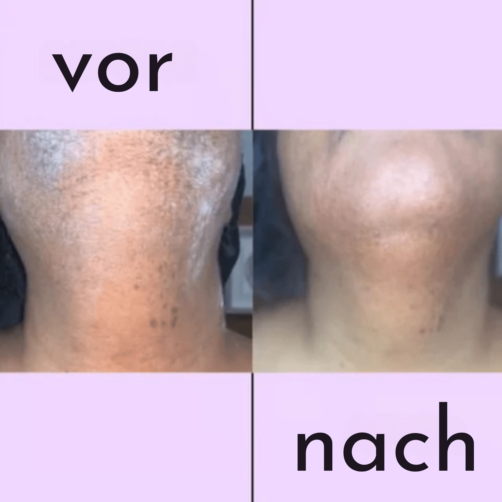 SoftSchön™ / Mühelose Haarentfernungscreme - Sopheria
