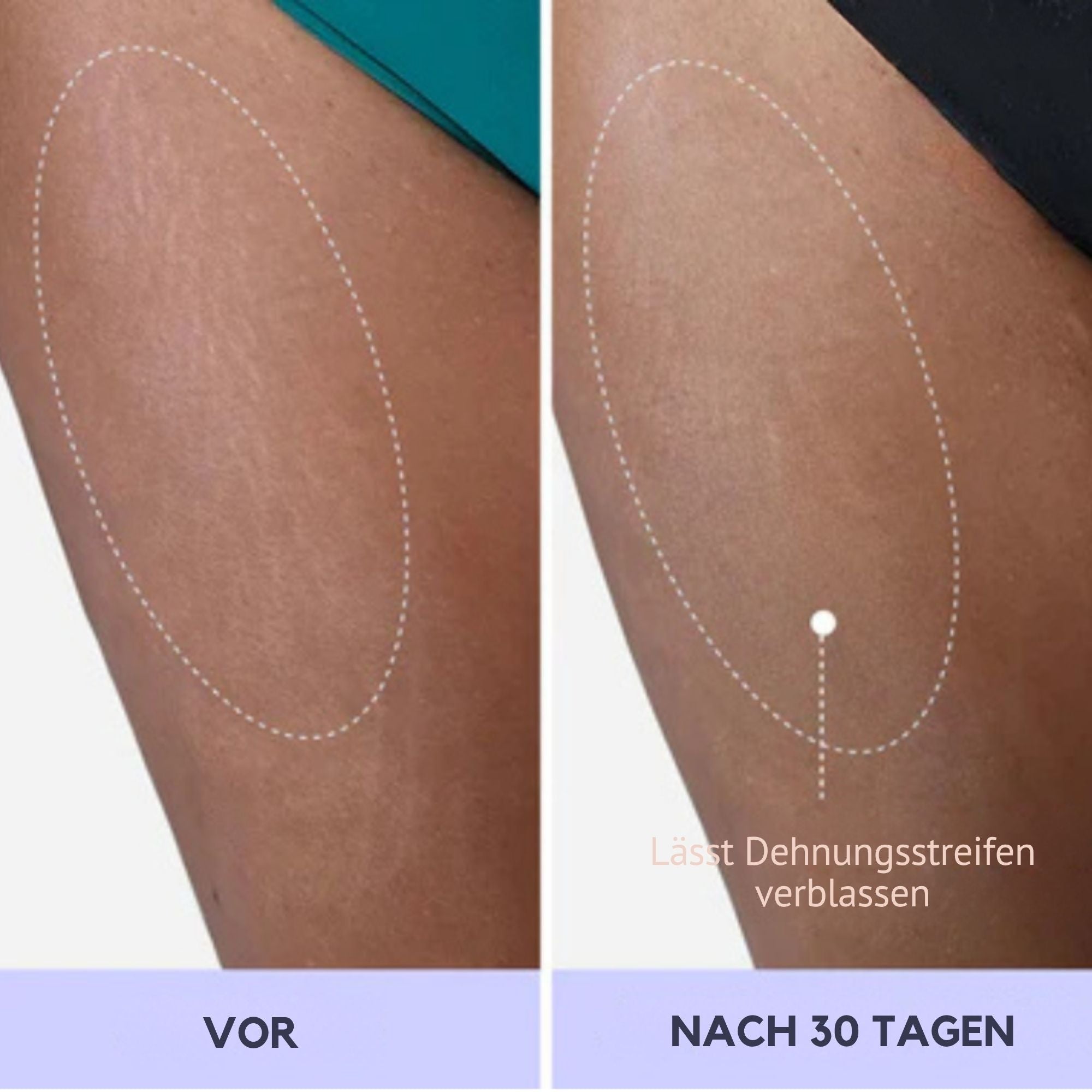 StraffSchön™ / Sag Hallo Zu Sichtbar Strafferer Haut! (1+1 GRATIS) - Sopheria