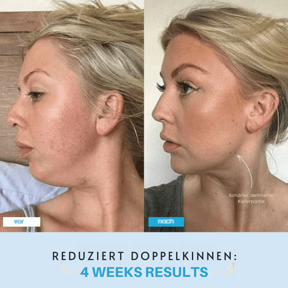 StraffStrom™ / Kombiniert LED-Lichttherapie mit Lifting-Effekten - Sopheria