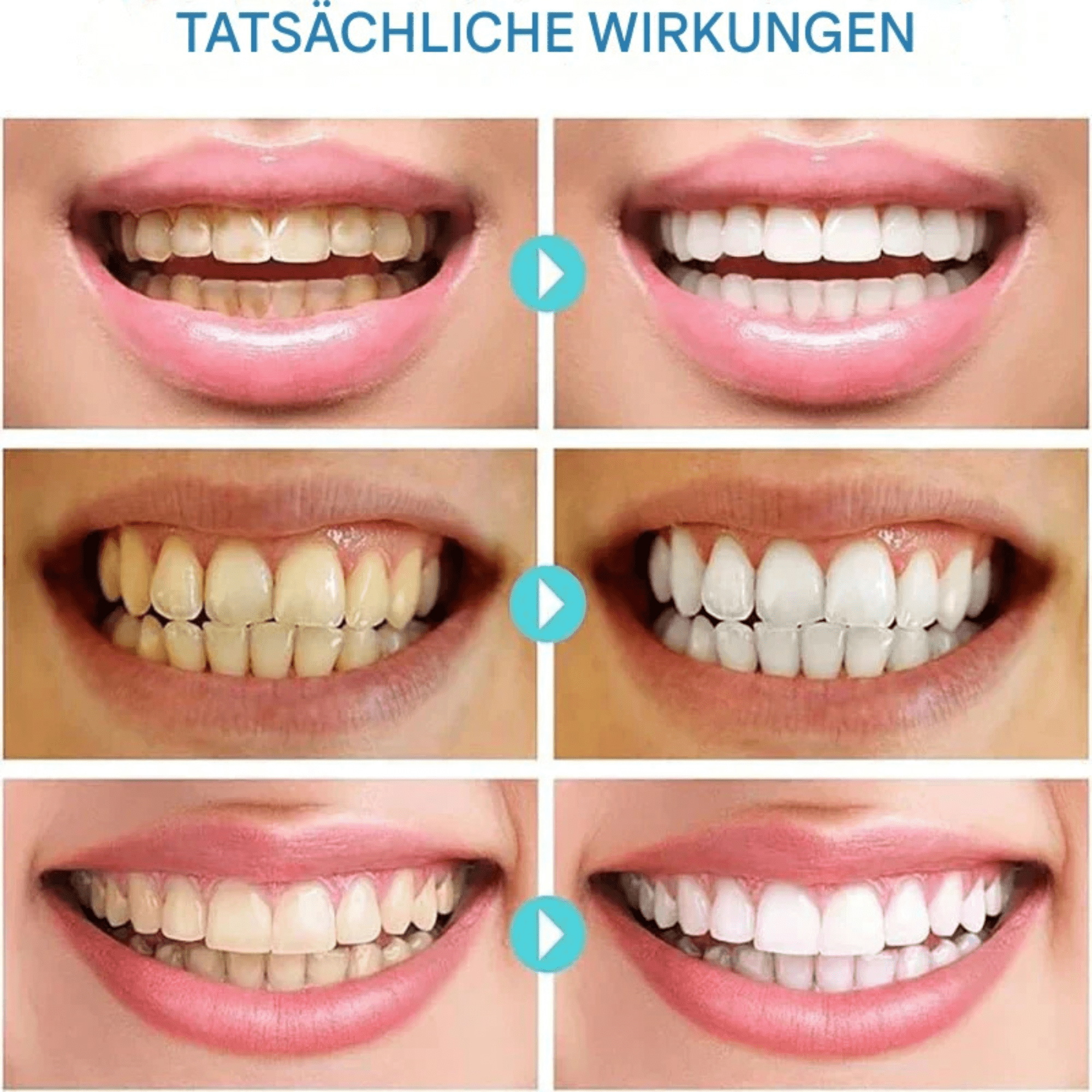 ZahnZart™ / Sofortige Aufhellung - Sopheria